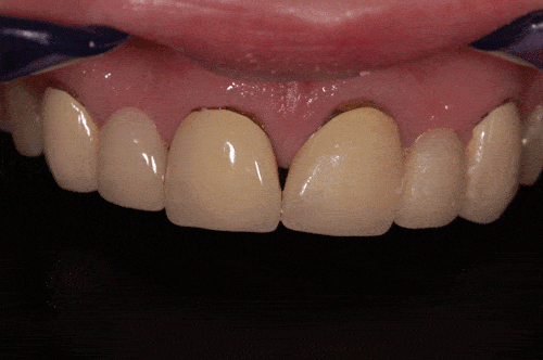 appearance of bridges before cosmetic dentistry